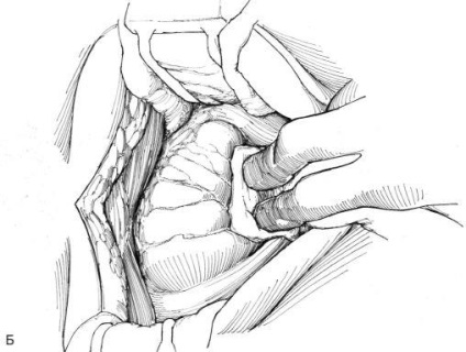 Eliminarea diverticulului vezicii urinare, hyman f