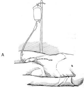 Eliminarea diverticulului vezicii urinare, hyman f