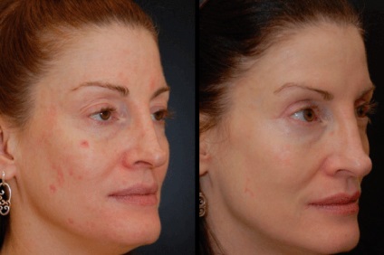 Îndepărtarea cicatricilor și a cicatricilor pe pielea tratamentului cu laser al feței, corectarea peelingului și a medicamentelor chimice