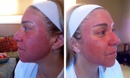 Îngrijirea pielii după îndepărtarea complicațiilor post-coajă de petele de pe față