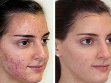 Îngrijirea pielii după îndepărtarea complicațiilor post-coajă de petele de pe față