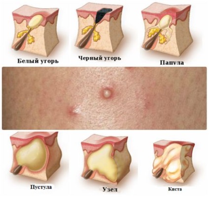 Tipuri și tipuri de acnee juvenil, la adulți, copii