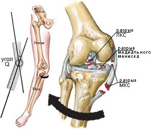 Разместване на колянната става могат бързо да бъдат излекувани