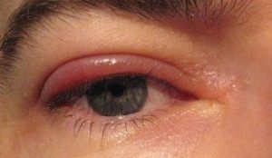 Inflamația ochiului