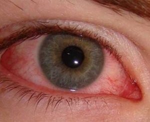 Inflamația ochiului