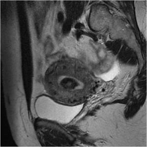 Boli ale miomei uterine - centrul chirurgiei endovasculare cu caprană
