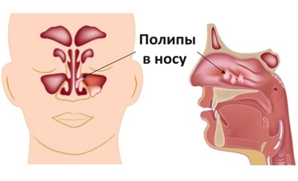 Звук хропіння як з'являється і від чого залежить його інтенсивність