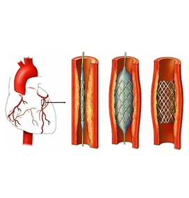 Echipament angiografic - siemens artis zee