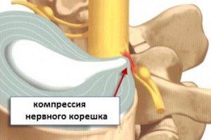 Mi a gerinc radicularis herniája?