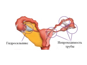 Care este procesul de adeziune în pelvis?