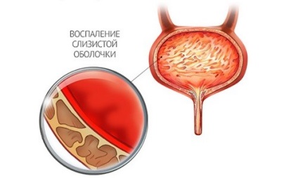 Cistita este transmisă sexual prin răspunsul la întrebare