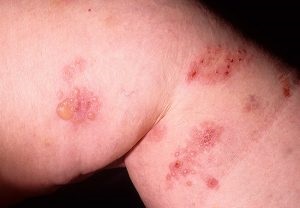 Dermatita duringa - tratament, simptome, fotografii la copii și adulți