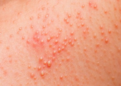 Dermatita uscată; cauzele și tratamentul bolii
