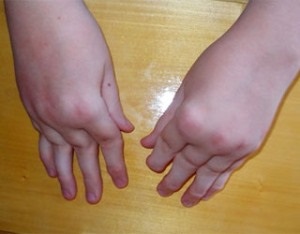 Artrita reumatoidă la copii - cauze de dezvoltare, simptome și tratament