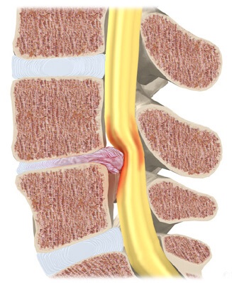 Endoprosthetics preț comun