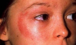 Tratamentul cu fotodermită a unei reacții alergice la soare