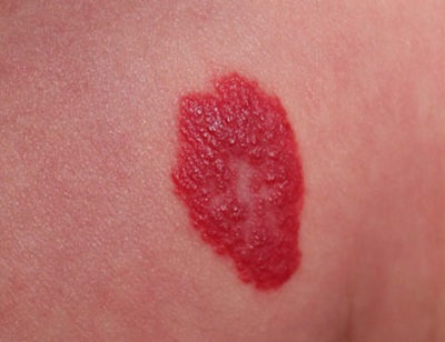 Hemangiomul pielii (semn de naștere vascular) ce este și ce să faceți