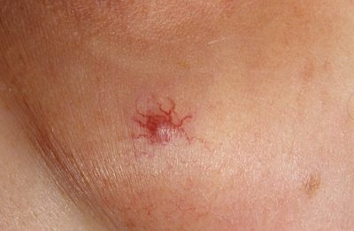 Hemangiomul pielii (semn de naștere vascular) ce este și ce să faceți