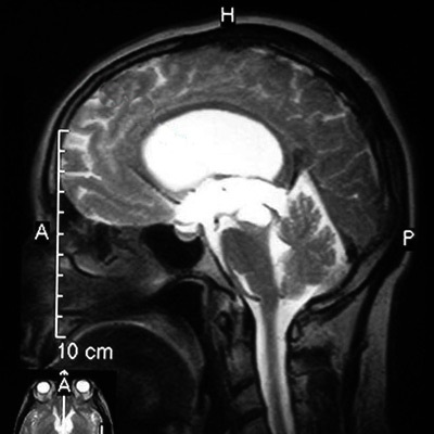 Agy hydrocephalus