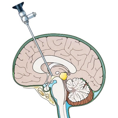 Agy hydrocephalus