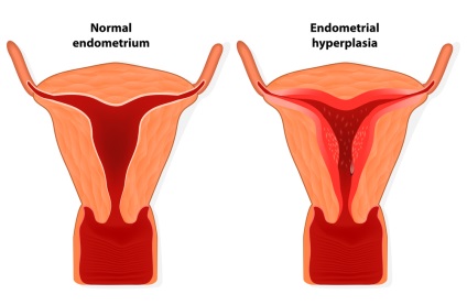 Hiperplazia endometrială