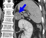 Hormonale-inactive tumorile suprarenale, p.