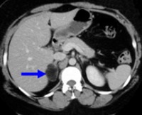 Hormonale-inactive tumorile suprarenale, p.