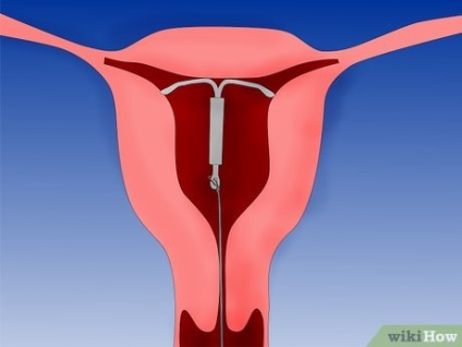Cum să identificați cervicita