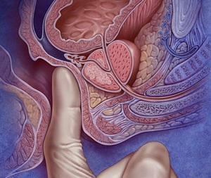 masaj de prostată prostatita cronică tratamentul prostatitei și adenomului pancreatic