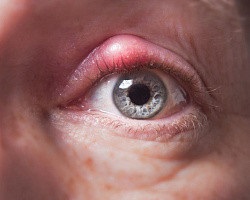 Cum să eliminați orzul din ochi rapid și eficient, sănătos online