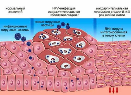 Hogyan néz ki a papillóma a testen és az arcán (fényképen)