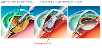 Cataracta la pacienții vârstnici Simptome și tratament