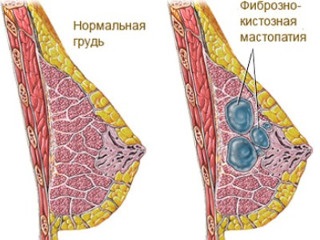 Fibroza chistică, care este mastopatia, tratamentul, prevenirea