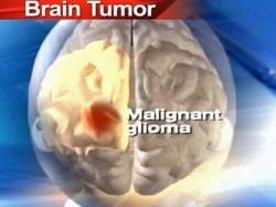 Clasificarea tumorilor cerebrale