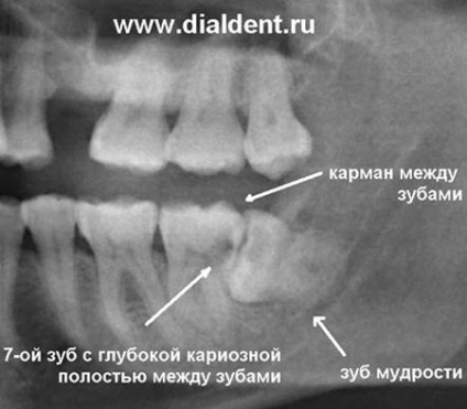 Atunci când îndepărtarea dintelui înțelepciunii devine o procedură necesară