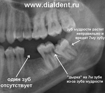 Atunci când îndepărtarea dintelui înțelepciunii devine o procedură necesară