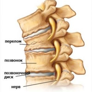 Exerciții terapeutice cu fractura de compresie a coloanei vertebrale