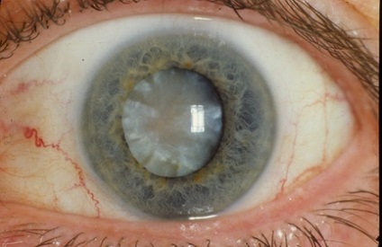 Cataract kezelés az idősekben - a népektől a műtét előtt