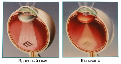 Tratamentul cu cataractă la vârstnici - de la oameni la căi înainte de operație