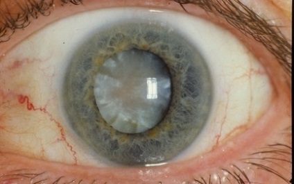Cataract kezelés az idősekben - a népektől a műtét előtt