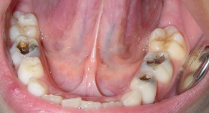 Tratamentul pulpitei din lapte și dinții permanenți la copii