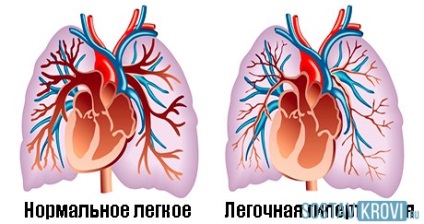 Hipertensiunea pulmonară ce este, cauze, simptome, tratament, prognostic