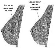 Mastopatia - simptome, tipuri, tratament