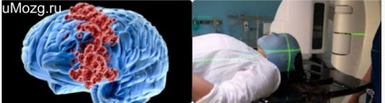 Meningiomul creierului după intervenție chirurgicală, prognostic
