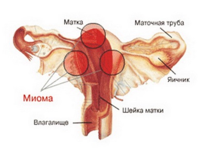 Miomul uterului