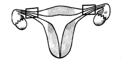 Pot ramane insarcinata daca trompele uterine sunt bandatate?