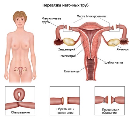 Pot ramane insarcinata daca trompele uterine sunt bandatate?