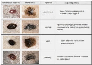 Detectarea melanomului pe cap sub păr