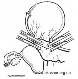 Chirurgie pe apendicele uterului