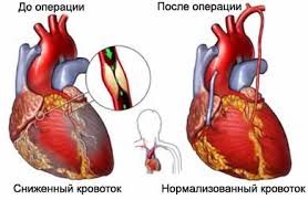 Stimulatoare cardiace, manevrare, transplant